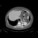 Diaphraghmatic hernia, Bochdalek hernia: CT - Computed tomography